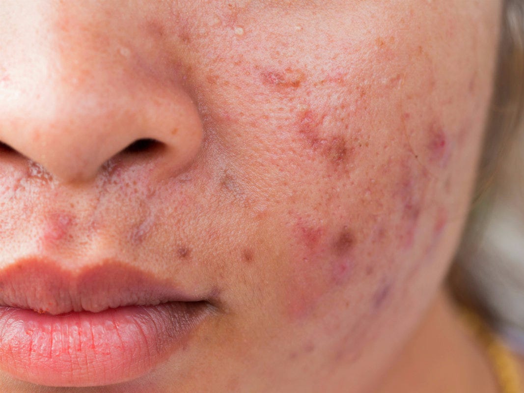 Skin Break Out Health And Skin Relationship E Clink News